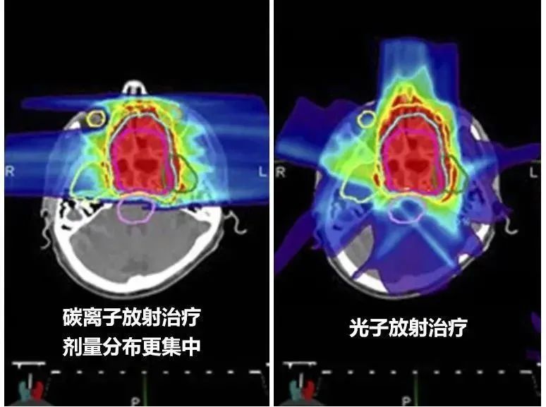 质子重离子“精准爆破”，攻克鼻咽癌