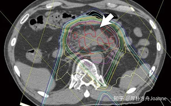 质子重离子治疗胰腺癌效果介绍