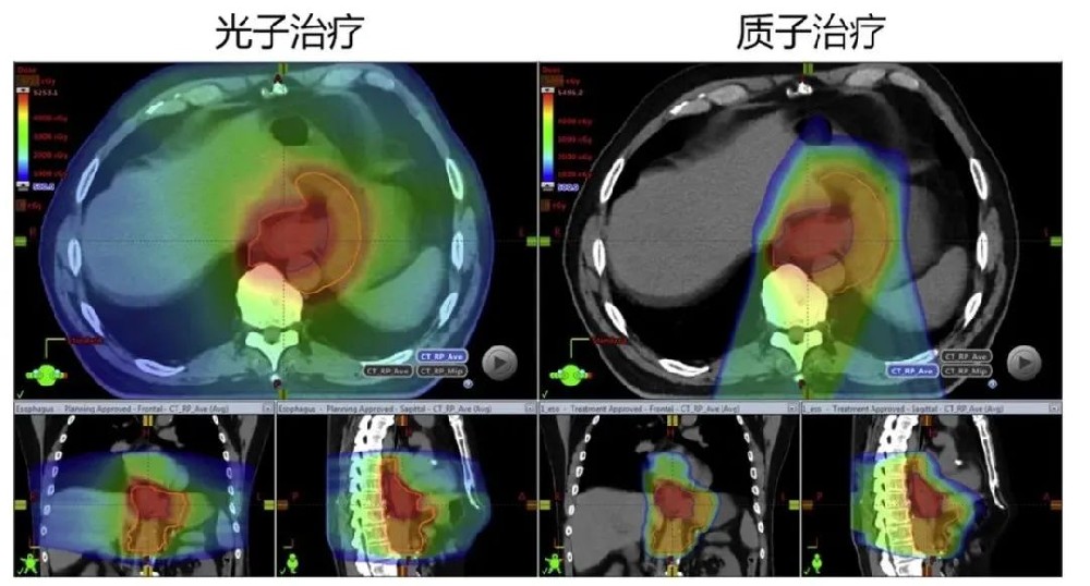 解密质子重离子治疗食管癌的优势